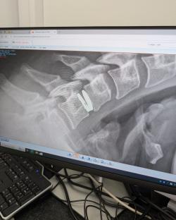 Cervical spine x-ray displayed on a computer screen.