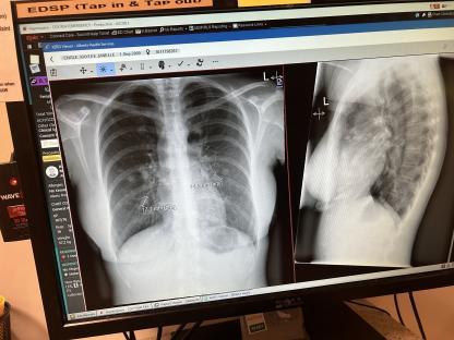 Chest X-ray showing multiple lung tumors.