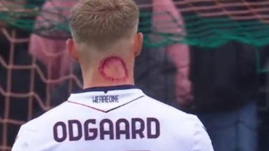 Serie A star forced to clarify he’s not been bitten by a ZOMBIE as pictures of nasty injury go viral