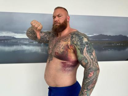 Hafþór JúlÃus Björnsson giving a thumbs down, showing a large bruise on his torso.