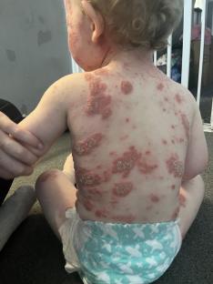 Toddler with severe eczema covering most of their body.