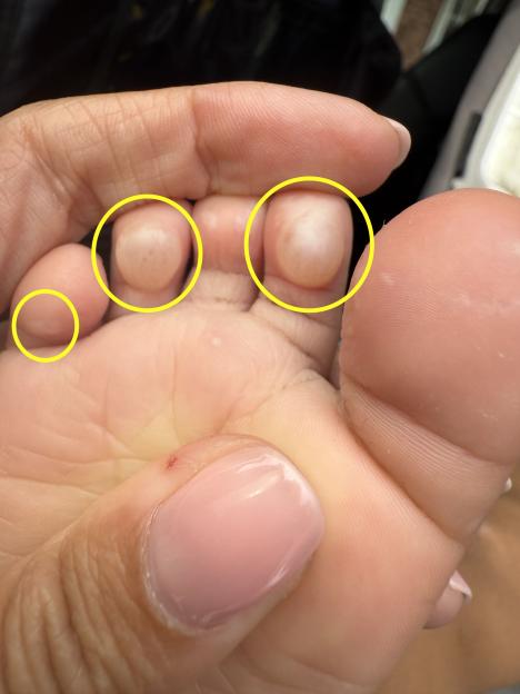 Close-up of a toddler's blistered toes after stepping on a hot fire pit.