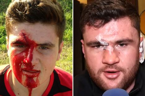 Johnny Fisher suffered horror BLOOD CLOT in his ear… but says he had worse injuries during his ‘posh’ rugby career