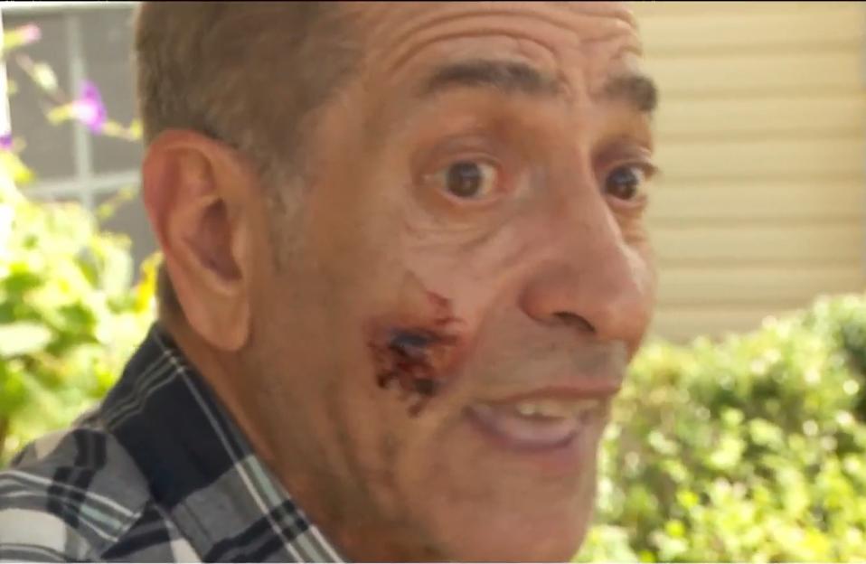 Man with facial injury from flare gun.