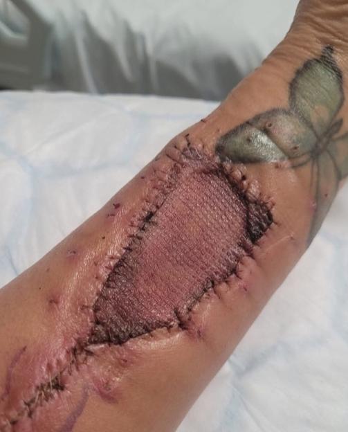 Close-up of a stitched wound on a woman's arm.