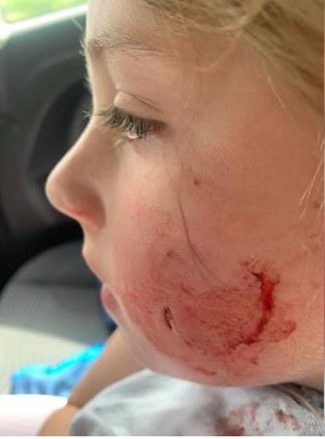 Pictured here are Kayla's injuries after the attack. An eight-year-old girl suffered horrific bite wounds to her face in an attack by a mystery dog while playing outside her gran's house. Animal-loving Kayla Watson was in her grandmother's front garden when a dog run up to start barking at her. Her mum Jade O'Hara said little Kayla tried to "shoo" the animal away - but it ferociously clamped its jaws around her cheek. It left Kayla covered in blood and screaming in terror in the school holiday attack. Jade said: "It all happened so quickly and as a mum it was a nightmare, I was so scared. WALES NEWS SERVICE