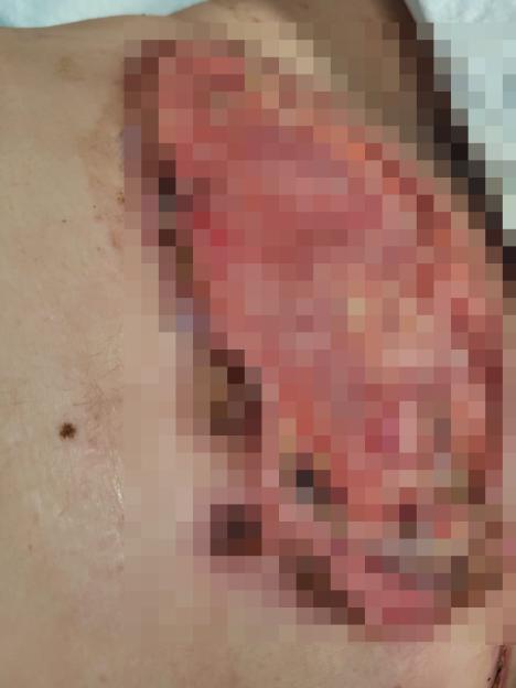 Infection after a botched tummy tuck procedure.
