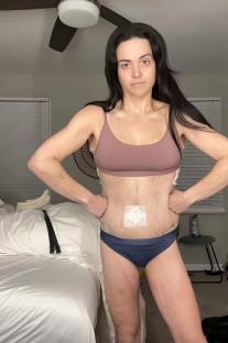Woman in underwear and sports bra, showing her abdomen after excess skin removal surgery.