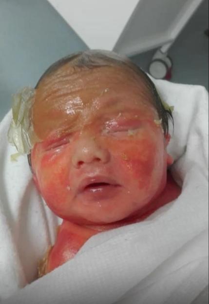 Newborn baby Caiden with red, shedding skin and a yellow wax-like membrane around his head, a symptom of congenital ichthyosis.