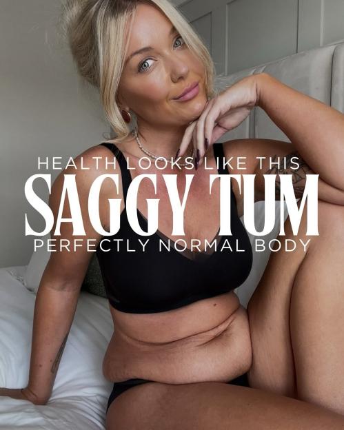 Woman in underwear showing her stomach, with text overlay reading "Health looks like this. Saggy Tum. Perfectly normal body."