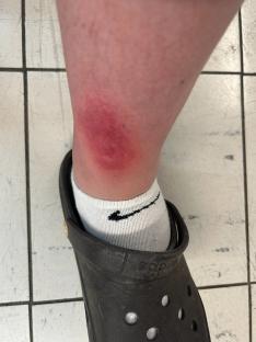 Spider bite on a person's ankle.