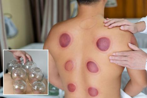 Teen riddled with killer infection that travelled to his heart after trendy cupping therapy goes horribly wrong