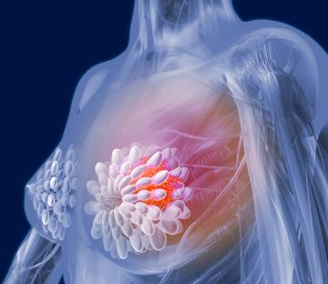 Illustration of breast cancer with a malignant tumor.