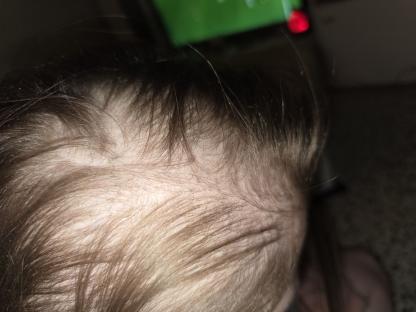 Close-up of a woman's scalp showing hair loss.