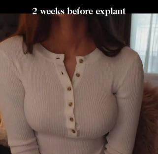 Woman's chest two weeks before breast implant removal.