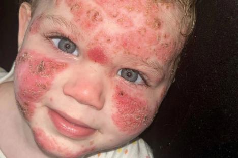 My baby’s head-to-toe rash bleeds and looks like chemical burns – cruel strangers are vile and kids won’t play with him