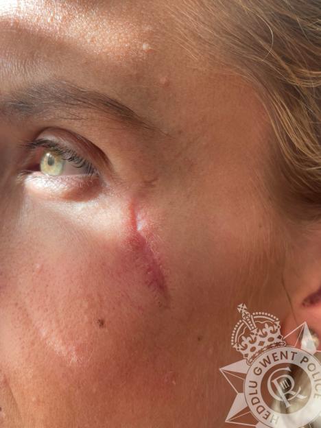 Close-up of a facial scar.