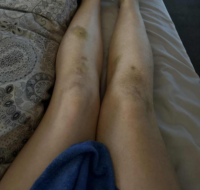 A woman's legs, covered in bruises and scrapes from a violent encounter.