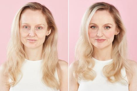 Fat jabs gave me Ozempic face with sagging cheeks and thin lips – but I’ve found solution WITHOUT fillers