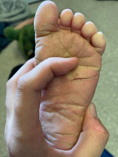 A hand holding a foot with dry, cracked skin.