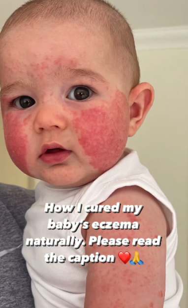 Baby with eczema.