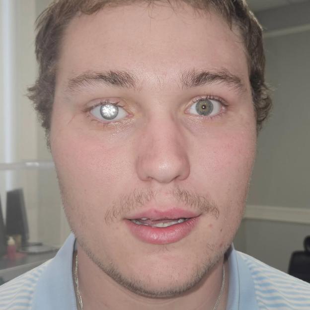 A man's face with one eye having a bright, sparkling contact lens.