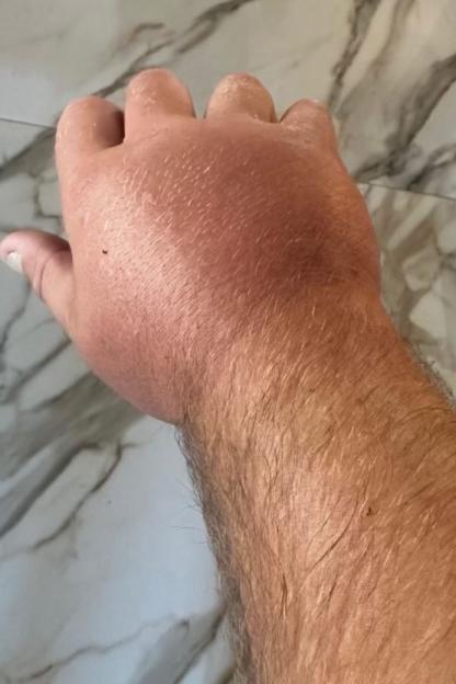 Swollen and reddened hand.