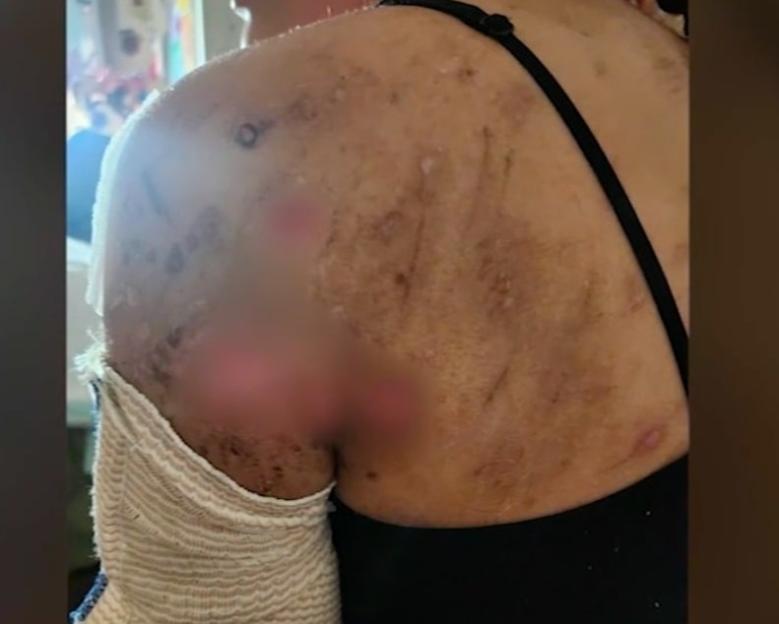 Dog bite injuries on a 17-year-old girl's back and shoulder.