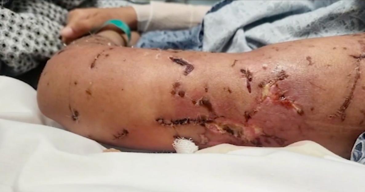 Severe dog bite wounds on a 17-year-old's arm.