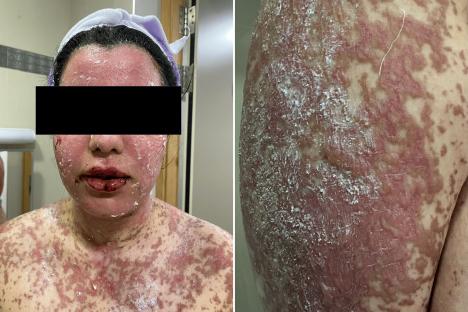 Woman, 24, watched a third of her skin ‘peel and detach’ from her body just four days after taking routine NHS drug
