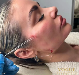 Close-up of a woman's face with sutures.