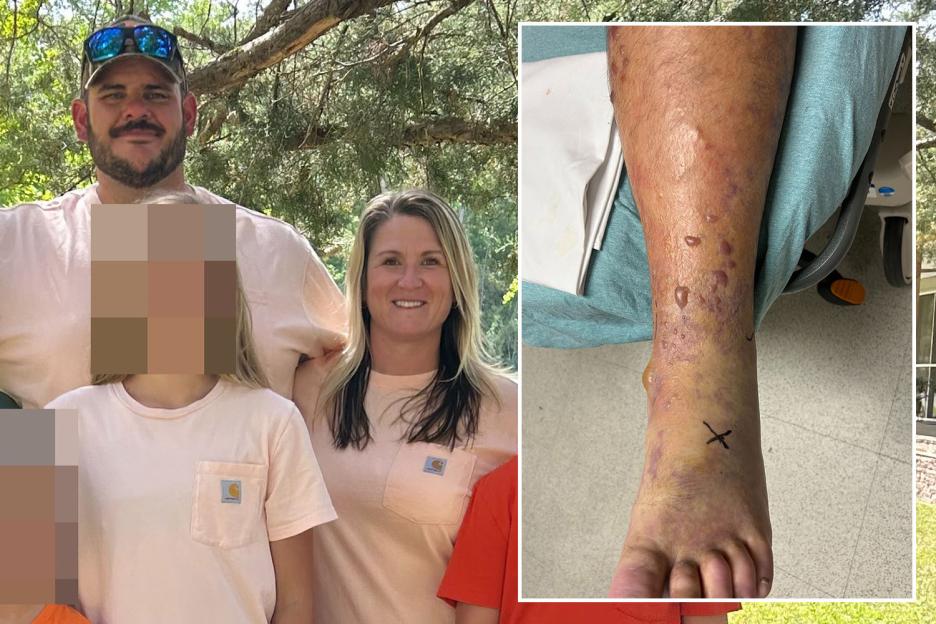 ‘Healthy’ dad left moments from death after ankle blister morphed into flesh-eating infection that shut down his organs