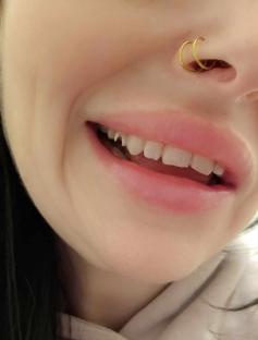 Close-up of chipped teeth.