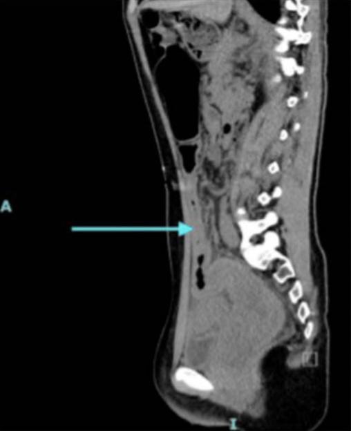 Sagittal view CT scan showing a massively distended colon.