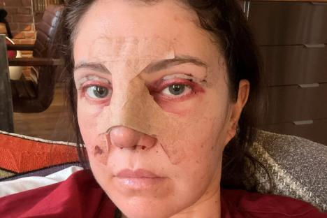 I spent £1.1K on specialist surgery to make me look more awake on my wedding day – yes, my fiancé became a live-in nurse