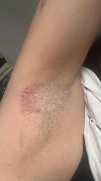 Photo of an underarm with a rash.