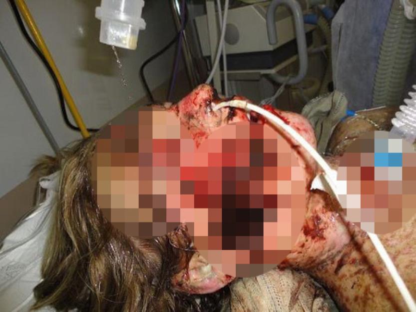 Graphic image of a woman with severe facial injuries in a hospital bed.