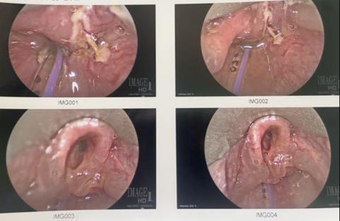 Collage of four endoscopic images showing damage to a child's esophagus from a swallowed button battery.