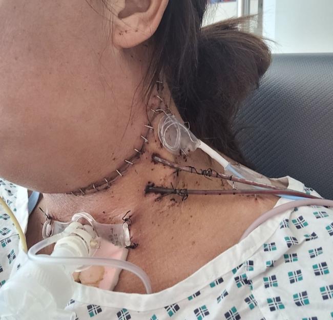 Close-up of a woman's neck showing a surgical incision and medical tubes.