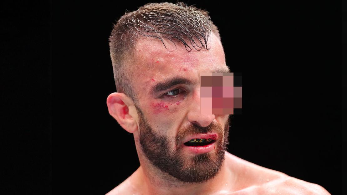 ‘What was the ref doing’ – Fans fear UFC star could lose his EYE after horror swelling sees fight called off