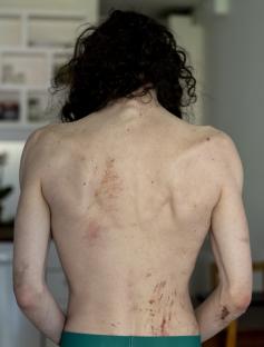 Person's back with scrapes and bruises.