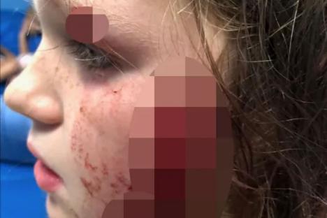Schoolgirl, 10, scarred for life after being viciously attacked by neighbour’s dog in front of horrified dad
