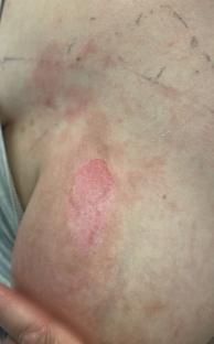 Close-up of a burn on a person's chest.