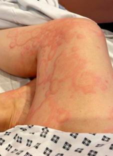 Close-up of a hand with a severe rash.