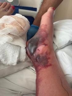 Severely infected wound on a woman's ankle.