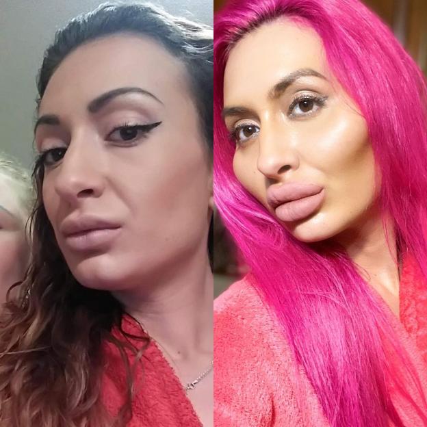 Collage of Anastasia Pokreshchuk before and after face fillers.