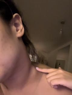 Close-up of a person's neck, pointing to a lump.
