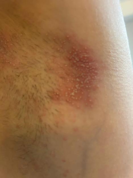 Close-up of an armpit with a rash.