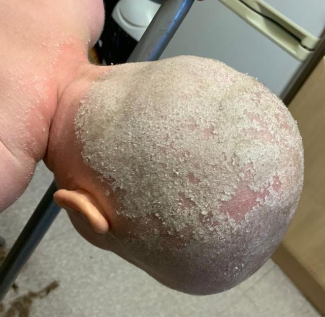 The head and shoulders of a child with congenital ichthyosis, showing flaky skin.