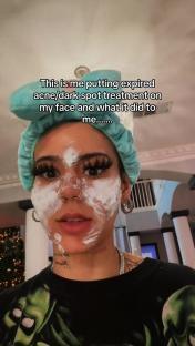 Person applying expired acne treatment to their face.